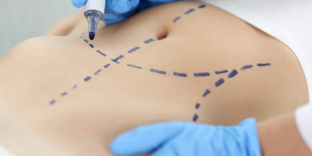 surgeon marking a portion of a tummy before performing a liposuction